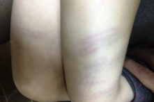 Thanh Hóa: Cô giáo mầm non dùng đũa đánh trẻ bầm tím đùi