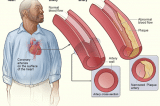 Coronary heart disease atherosclerosis