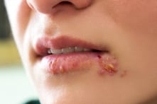 Dấu hiệu và cách chữa trị bệnh “giời leo”