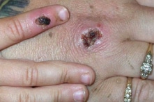 WHO cân nhắc đổi tên bệnh đậu mùa khỉ vì lo ngại kỳ thị và phân biệt chủng tộc