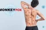 WHO: Chưa cần thiết tiêm vắc-xin phòng bệnh đậu mùa khỉ trên diện rộng