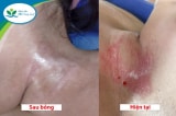 be gai 19 thang tuoi bi bong do hoa chat tay dau mo 0