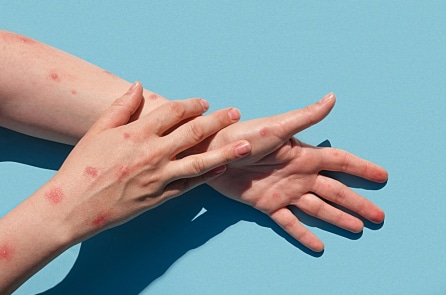WHO dự định đổi tên virus đậu mùa khỉ thành “MPOX” để “tránh kỳ thị”