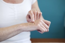 Tuổi tác không phải là nguyên nhân duy nhất gây ra các đốm đồi mồi