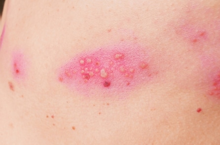 Mề đay, chàm, zona: Điều trị các chứng bệnh ngoài da theo mùa bằng Trung y