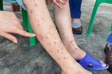 Hà Tĩnh: Bọ chét hút máu khiến 126 người bị viêm da dị ứng