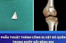Bác sĩ phẫu thuật lấy ra mảnh sành nằm trong khớp gối bé gái 2 năm