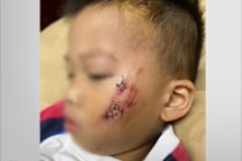 Chó nhà nuôi nghi dại cắn rách má bé trai 2 tuổi ở TP. Biên Hòa