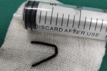 Đinh sắt hoen gỉ cong chữ U trong cổ bệnh nhi 8 tuổi