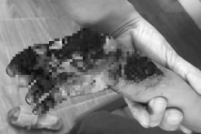 Cầm đầu dây sạc điện thoại vẫn cắm điện, bé 3 tuổi bị giật cháy tay