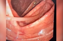 Đi khám, người phụ nữ thích ăn gỏi cá phát hiện ký sinh trùng trong ruột