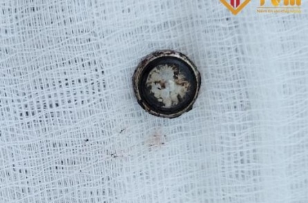 Sóc Trăng: Cục pin cháy khét trong mũi bé gái 4 tuổi khiến thủng vách ngăn