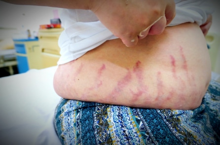 Trẻ bị suy thượng thận do lạm dụng thuốc xịt mũi có chứa corticoid
