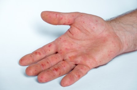 Đức phát hiện trường hợp đầu tiên nhiễm biến thể mới của virus đậu mùa khỉ