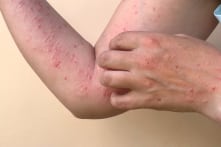Trung Quốc phát hiện cụm dịch đậu mùa khỉ