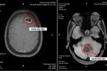 Thường xuyên ăn tiết canh, sán làm tổ trong não