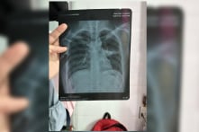 Việt Nam tăng thêm 78.674 ca bệnh lao mới, 2.764 ca kháng đa thuốc