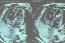 Thêm một ca thông tim can thiệp xuyên tử cung cứu bào thai