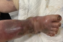 Suy tuyến thượng thận, nhiễm trùng nặng vì lạm dụng thuốc chứa corticoid