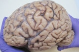 Brain autopsy lateral view