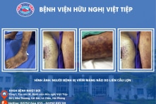 Thường xuyên ăn nem chua, thịt lợn tái, người đàn ông bị viêm màng não