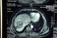 Thường xuyên ăn sống rau muống, rau ngổ, người đàn ông bị sán lá gan lớn ký sinh