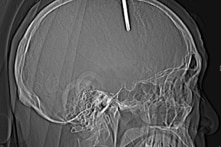 Bế tắc, người đàn ông trầm cảm tự đóng đinh vào đầu