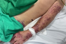 Chế biến thủ lợn, người đàn ông 52 tuổi nhiễm khuẩn liên cầu lợn