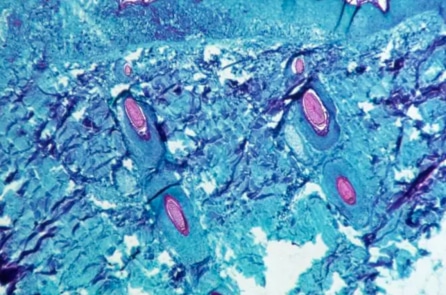 WHO: Mpox không phải là Covid-19 mới, không cần phải phong tỏa