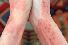 5 nguyên nhân gây bệnh chàm và cách chữa tự nhiên qua ăn uống