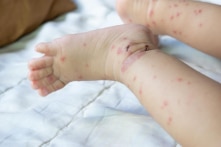 Bộ Y tế họp khẩn về dịch sởi: Nguy cơ bùng phát trên diện rộng