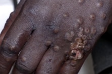 Phát hiện bệnh đậu mùa khỉ ở Pakistan