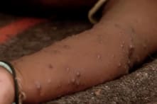 Dịch đậu mùa khỉ lây lan ở châu Âu, Thụy Điển báo cáo ca bệnh đầu tiên