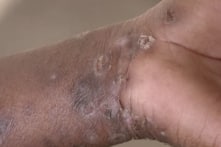 Philippines phát hiện ca đậu mùa khỉ đầu tiên trong năm nay