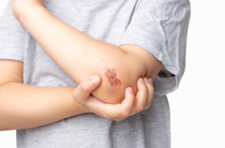 Hợp chất mới giúp chữa lành vết thương không để lại sẹo – Nghiên cứu