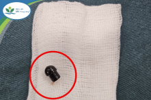 Bé trai 7 tuổi tử vong do hóc đầu nắp bút