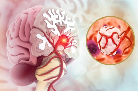 Tìm hiểu về bệnh ung thư não ác tính khiến diễn viên Quý Bình qua đời