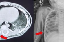 Ngã ngửa từ trên giường xuống đất, bé 1 tuổi bị vỡ khí quản hiếm gặp, gãy 3 xương sườn