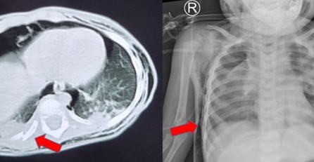 Ngã ngửa từ trên giường xuống đất, bé 1 tuổi bị vỡ khí quản hiếm gặp, gãy 3 xương sườn