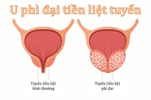 U phì đại tiền liệt tuyến: Đừng xem nhẹ