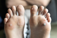 Mụn cóc gan chân: Triệu chứng, nguyên nhân, điều trị và liệu pháp tự nhiên