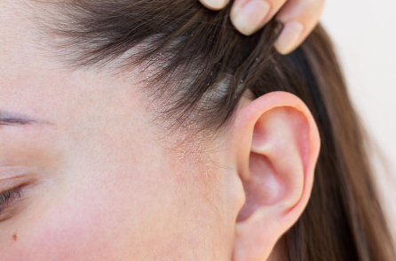 4 yếu tố ảnh hưởng đến viêm da tiết bã và cách điều trị