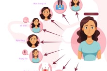 Hội chứng buồng trứng đa nang: Một rối loạn nội tiết cần được chăm sóc toàn diện
