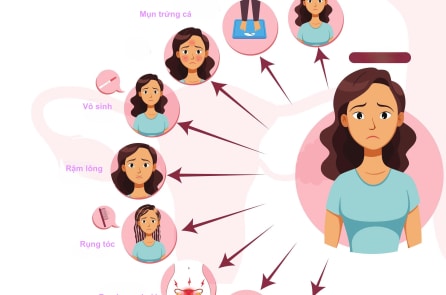Hội chứng buồng trứng đa nang: Một rối loạn nội tiết cần được chăm sóc toàn diện