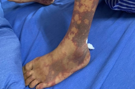 Số ca mắc liên cầu lợn tăng đột biến tại Huế, 1 ca tử vong, nhiều ca xin về