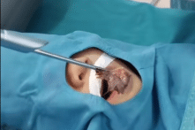 Bé trai 4 tuổi bị cá rô sống chui tọt vào cổ họng