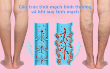 Suy tĩnh mạch ở người lớn tuổi: Cách nhận biết và điều trị