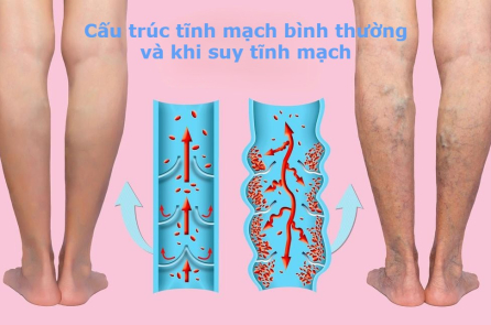 Suy tĩnh mạch ở người lớn tuổi: Cách nhận biết và điều trị