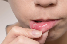 Cách điều trị loét miệng tại nhà