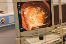 TQ: Bé gái ăn tóc trong thời gian dài, bác sĩ lấy ra 2 chậu tóc trong dạ dày